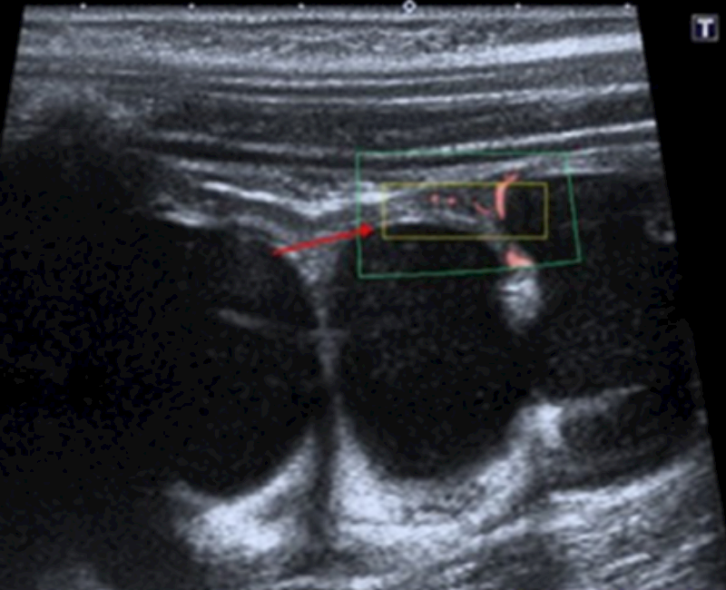 Ultrasound evaluation of stiffness and vascularity of renal parenchymal damage secondary to hydronephrosis in pediatric patients using shear wave elastography and superb microvascular imaging